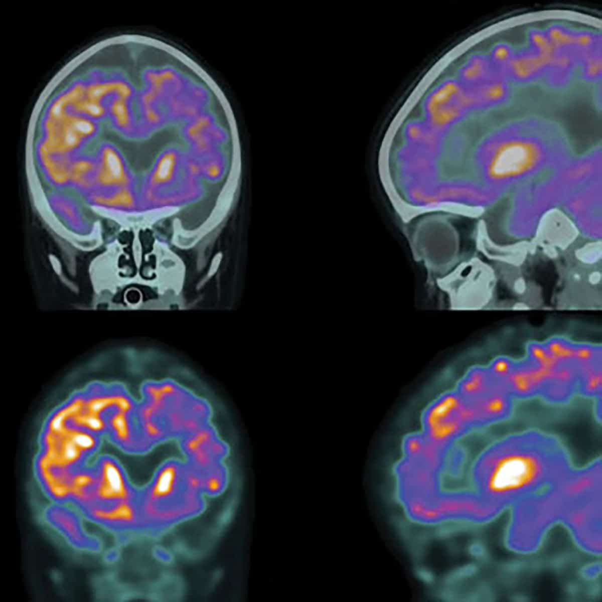 Ein Aktivitätsscan eines Hirns von vier Seiten